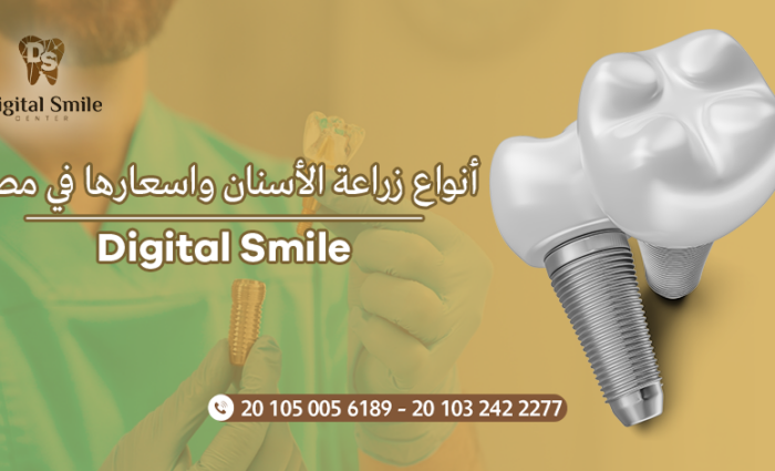أفضل أنواع زراعة الأسنان واسعارها