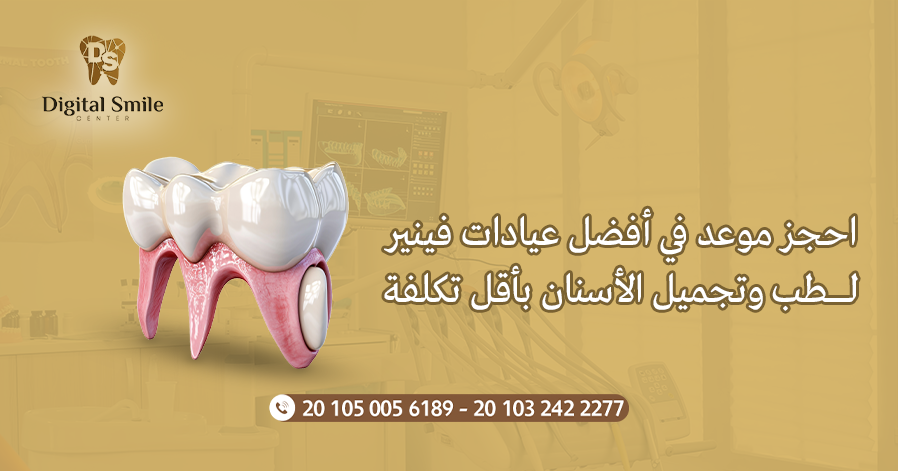 عيادات فينير لطب وتجميل الأسنان في القاهرة