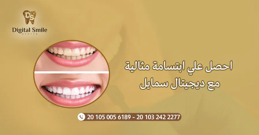 احصل علي ابتسامة مثالية مع ديجيتال سمايل