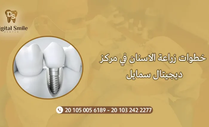 خطوات زراعة الاسنان في مركز ديجيتال سمايل