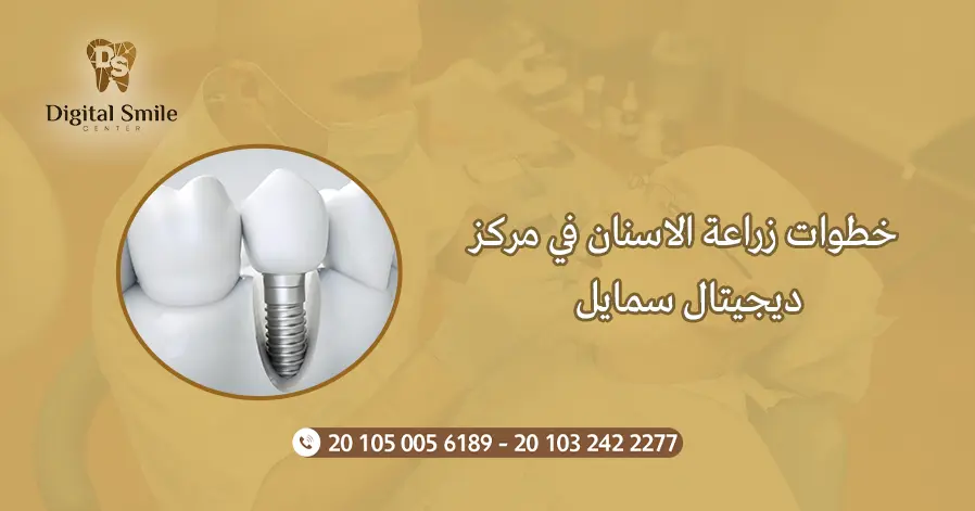 خطوات زراعة الاسنان في مركز ديجيتال سمايل